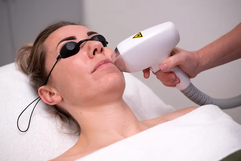 Diode laser ontharen van het gezicht met beschermbril